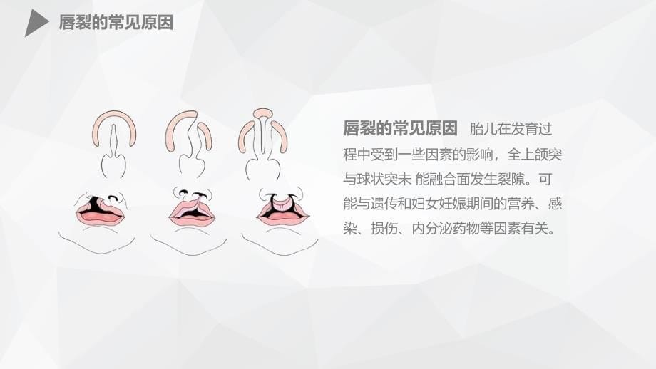 幼儿唇裂的护理查房 (2)_第5页